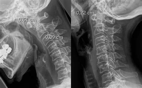 Evolving Management Of Cervical Spine Instability In Ra Rheumatology