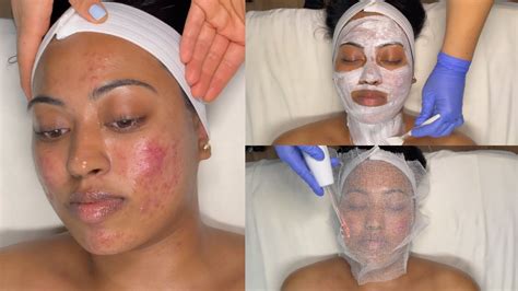 Cystic Acne Treatment Walk In Facial For Grade 3 And 4 Acne With Pro