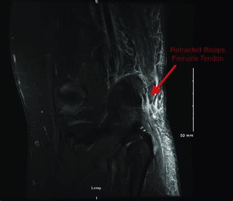 Coronal Magnetic Resonance Imaging Scan Showing Rupture Of The Left