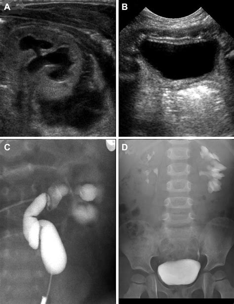 Coexisting Ureteropelvic Junction Obstruction And Ureterovesical