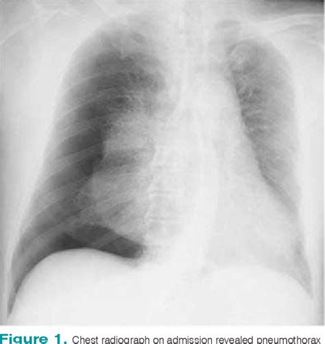 Figure 1 From Hemothorax After Chest Tube Insertion For Pneumothorax As