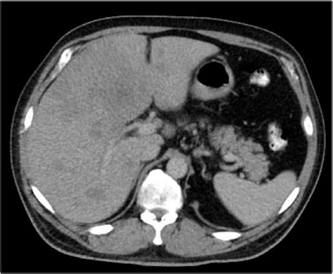 Axial View Of Ct Abdomen And Pelvis Demonstrating Multiple Liver Masses
