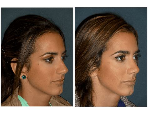 Before And After Gallery Houston Tx Houston Sinus Surgery