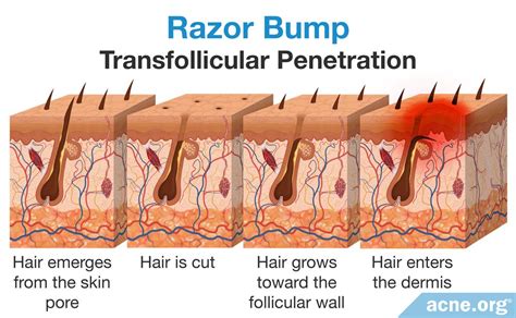 What Are Razor Bumps Acne Org