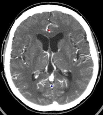 Ct scans and mri scans are two medical imaging methods that create detailed images of internal body parts, including bones, joints, and organs. CT Brain with or without Contrast