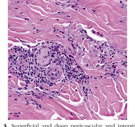 Figure 3 From Eosinophilic Dermatosis Of Hematologic Malignancy