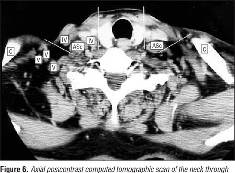 An Imaging Based Classification For The Cervical Nodes Designed As An
