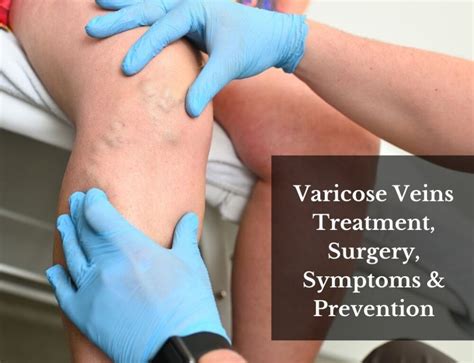 Varicose Veins And Spider Veins Causes And Treatments
