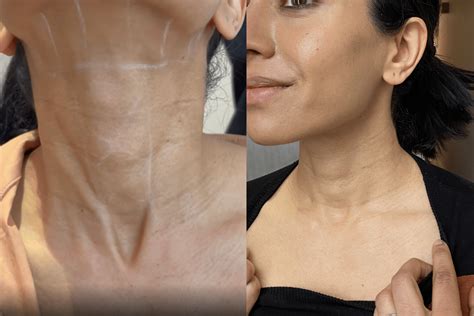 Best Treatment For Neck Wrinkles According To An Expert
