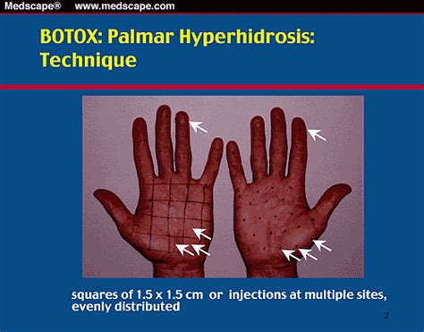 Hyperhidrosis Current Understanding Current Therapy