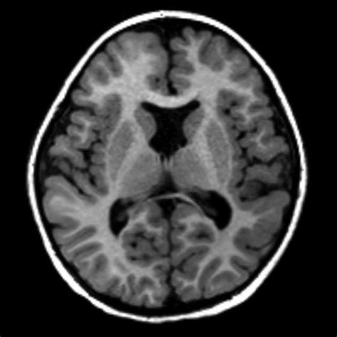 Septo Optic Dysplasia Enlarged Lateral Ventricles With An Absent