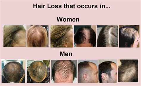 Causes And Symptoms Of Hair Loss