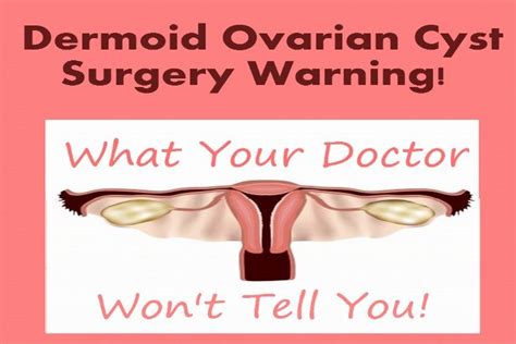 Dermoid Ovarian Cyst Surgery Warning Dermoid Ovarian Cyst Ovarian
