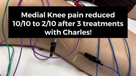 Electro Acupuncture For Medial Knee Pain Youtube