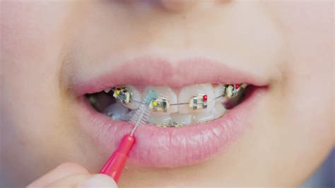 Close Up Braces On The Girls Stock Footage Video 100 Royalty Free 1024934153 Shutterstock