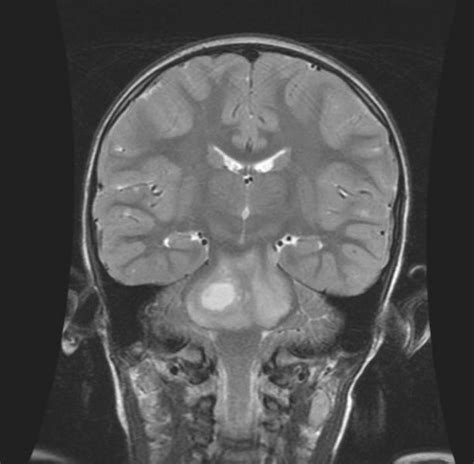 Brain Stem Gliomas Mri Wikidoc