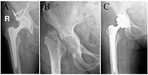 Jcm Free Full Text Complications Of Resection Arthroplasty In Two