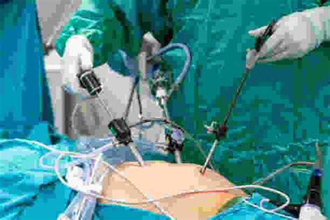 What Is A Laparoscopy Procedure Laparoscopic Surgeries