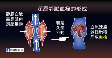 甲亢 高尿酸血症 痛风 甲 脑血栓 胶质瘤 垂体瘤 脑垂体瘤 脑膜瘤 脑震荡 脑动脉瘤 烟雾病 脑疝 植物人 脊髓损伤 瘫痪. 久坐不動當心經濟艙症候群 - 深層靜脈血栓（懶人包） - 照護線上