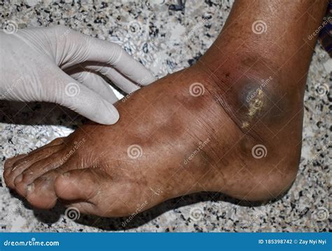 Doctor Examining Swollen Foot Or Pitting Oedema In Foot Of Patient With