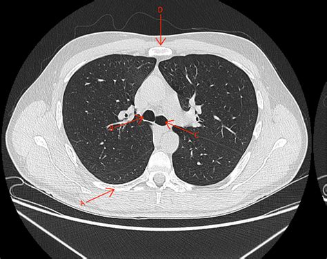 Lung Window Q2 My Ct Registry Review