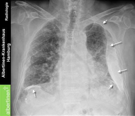 R Thorax Asbestose Plaques Pa Doccheck