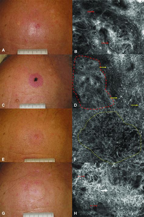 Micronodular Basal Cell Carcinoma On The Forehead A Baseline Clinical Download Scientific