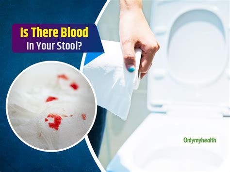 Have You Ever Experienced Blood In Your Stool These Could Be The