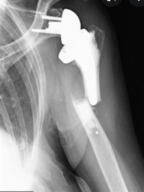 Uw Shoulder And Elbow Academy Safe Bone Preserving Fixation Of The
