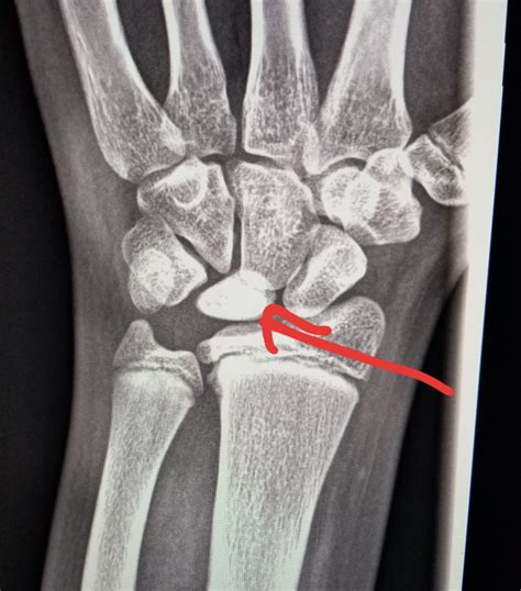 Wrist Xray Abnormal Density Sclerosis Of The Lunate Bone Kienbock