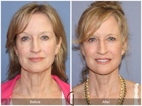 Facelift Fifties Before And After Photos Patient 51 Dr Kevin Sadati