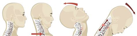 Whiplash Definition Causes Symptoms Diagnosis And Treatment