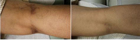 Welcome to another episode of, ask dr. Frequently Asked Questions on Leg Veins and Spider Veins