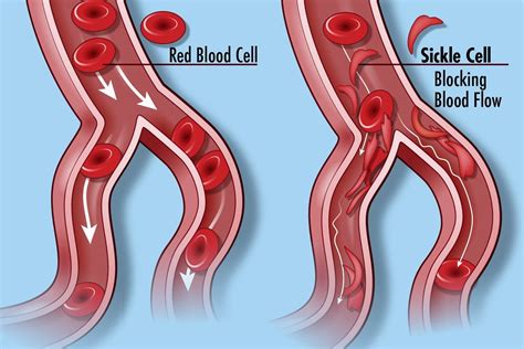 Sickle Cell Disease Sickle Cell Disease Scd Occurs In Pe Flickr