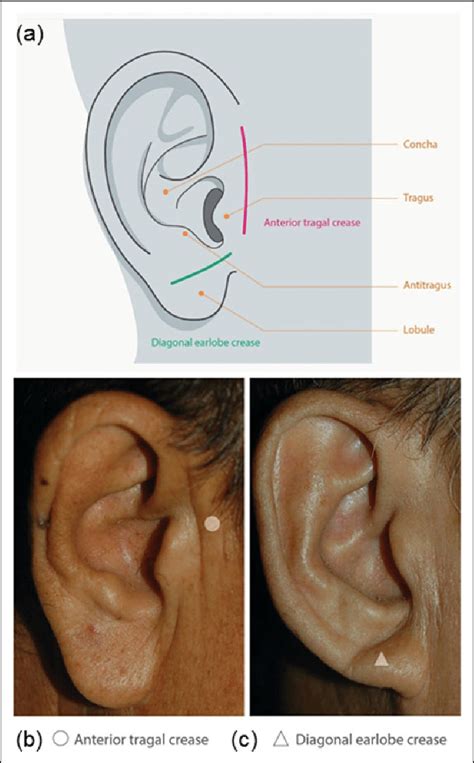 A Ear Crease In Relation To Normal Ear Anatomy B Anterior Tragal