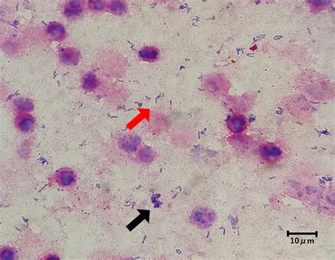 Gram Stain Of Bile Revealed Gram Positive Rods Without An Elongated