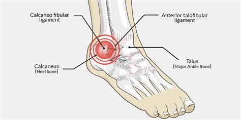 Ankle Instability The Complete Injury Guide Vive Health