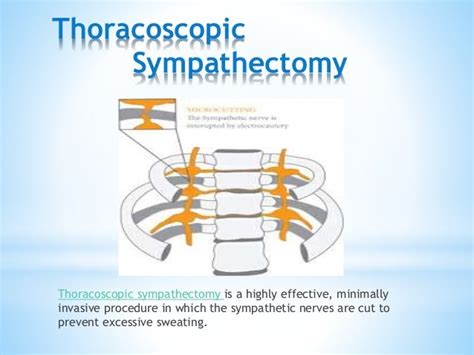 Thoracoscopic Sympathectomy Los Angeles Hyperhidrosis Md