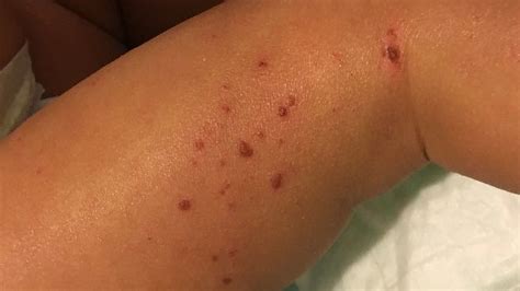 Types Of Skin Rashes And How To Treat Them