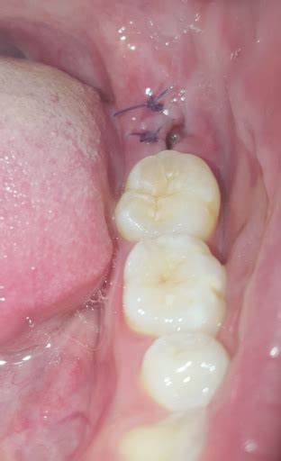 Sore Lump After Wisdom Tooth Extraction