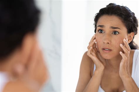 10 Best Dermatitis Creams For Your Face Best Dermatitis Cream