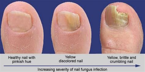 Thick Toenails Causes Pictures How To Get Rid Symptoms Treatment