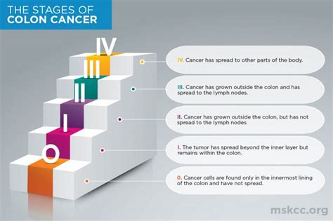 Colon Cancer Stages 0 1 2 3 4 Memorial Sloan Kettering Cancer Center