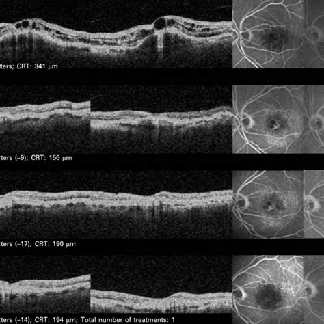 Retinal Angiomatous Proliferation Treated With 1 Mg Intravitreal