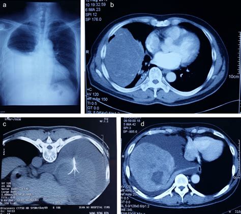 Chest Radiography And Computed Tomography Ct Scan Images A A Plain