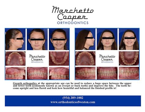 before and after marchetto cooper orthodontics weston fl