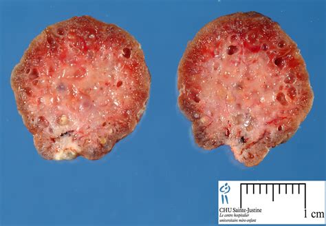 rectal polyps - Humpath.com - Human pathology