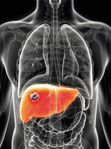 Hepatocellular Carcinoma Signs And Symptoms Mims Vietnam