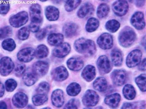 Histopathology Images Of Small Lymphocytic Lymphoma By