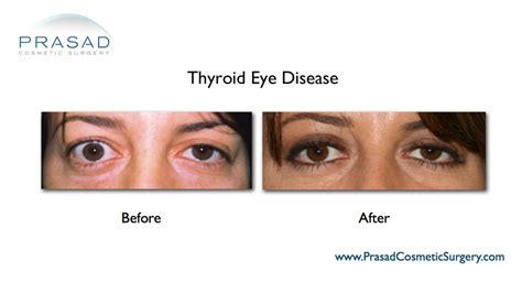 Thyroid Eye Disease Surgery Graves Eye Disease Surgery Dr Prasad